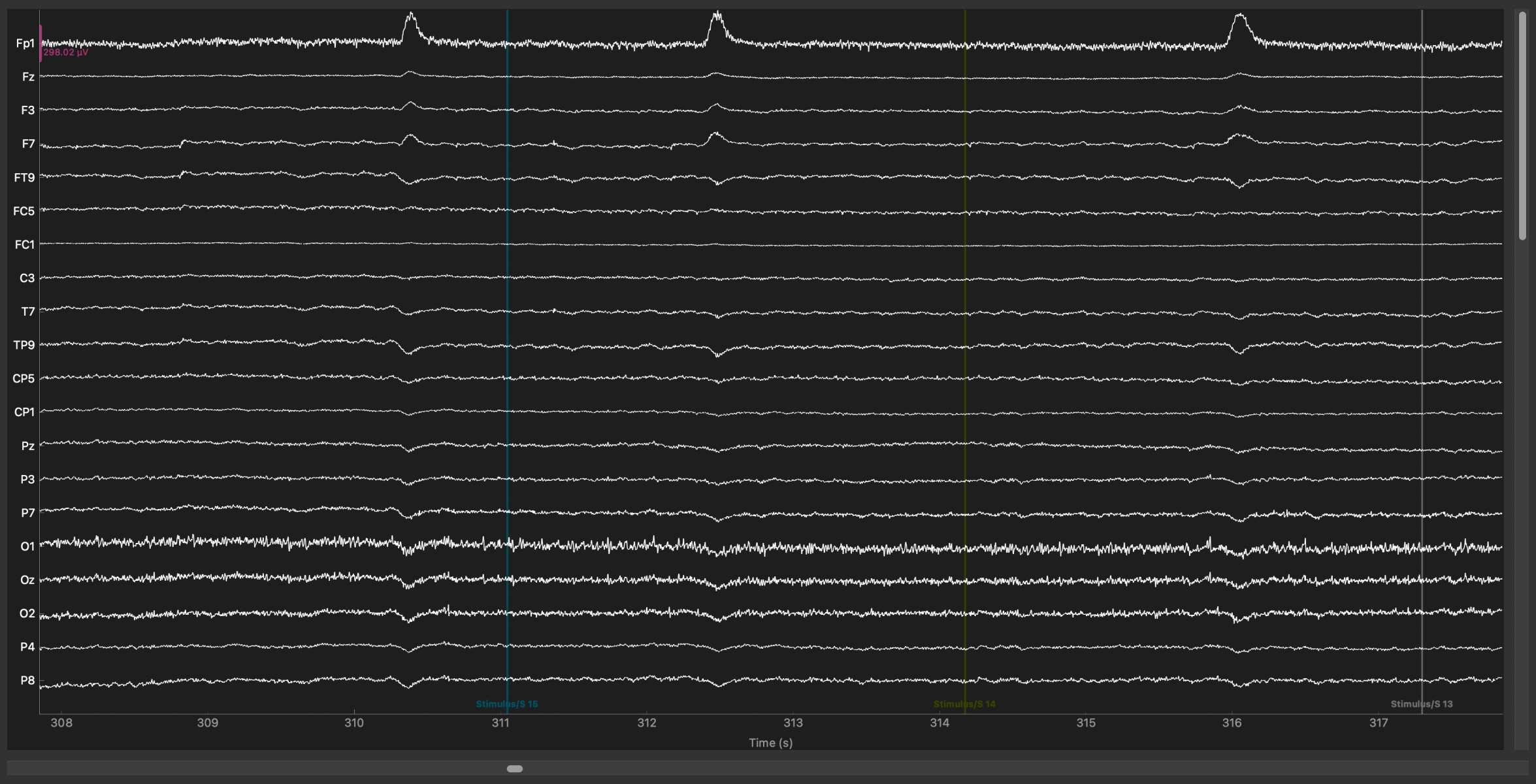 EEG Machine Brain Scan on Computer Screen